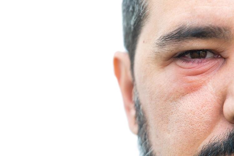 ways-to-get-rid-of-a-cyst-on-the-eyelid